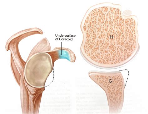 Latarjet and Failed Shoulder Instability Repair | Shoulder Injuries | Dr. Christopher Ahmad