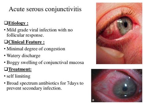 Viral conjunctivitis