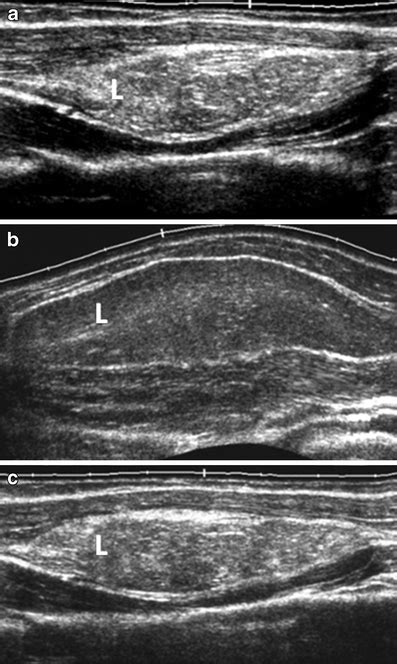 Ultrasound features of deep-seated lipomas | SpringerLink