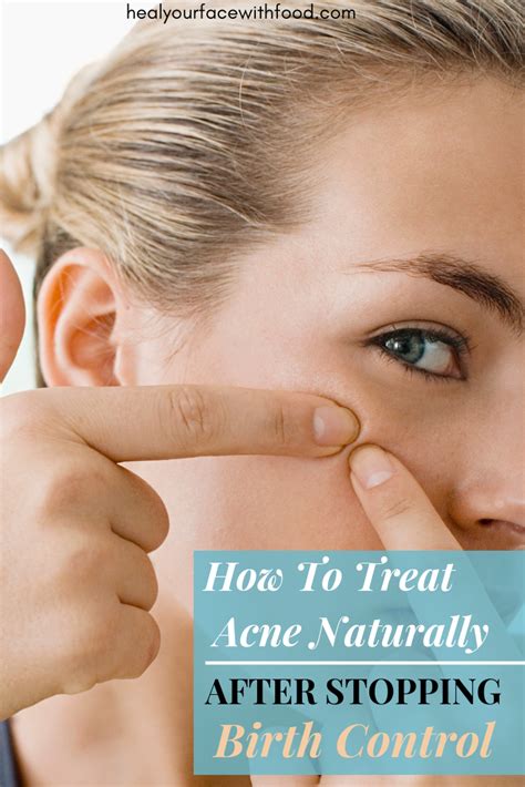 Treat acne after stopping birth control - how to heal hormonal acne naturally – Heal Your Face ...