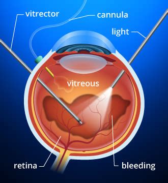 Vitrectomy and Vitreoretinal Procedures - All About Vision