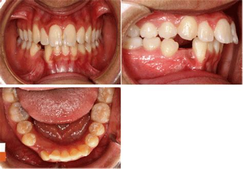 Orthodontic management of an impacted mandibular canine of a Kuwaiti ...