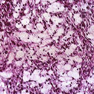 Histologic section of a fibrous cortical defect demonstrating typical... | Download Scientific ...