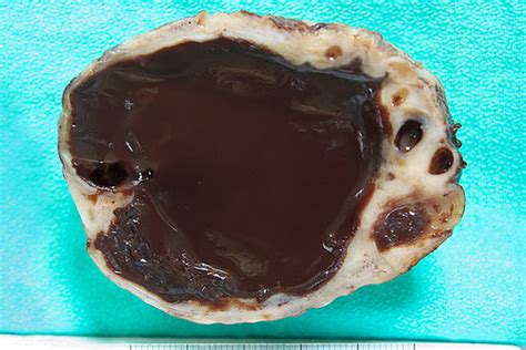 Ovarian Endometriotic Cyst | The so-called "chocolate cyst" … | Flickr