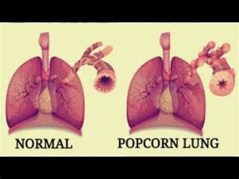 Does Vaping Cause Popcorn Lung? ( Vaping360 Article ) Vape Discussion ...