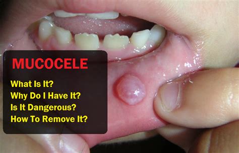 Mucocele: Symptoms, Causes, Effective Remedies and Removal | Remedies