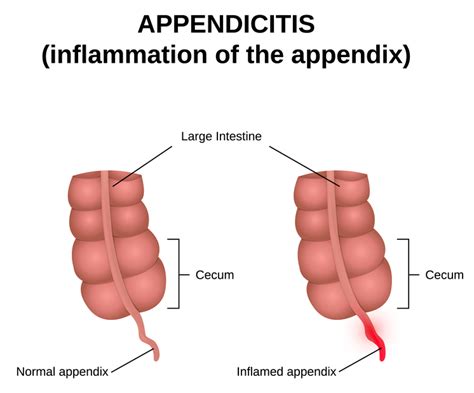 Appendicitis: Symptoms, Causes, and Treatment - University Health News