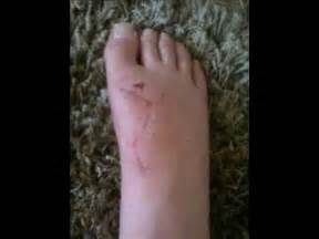 My Foot after Tendon Repair Surgery until today - YouTube