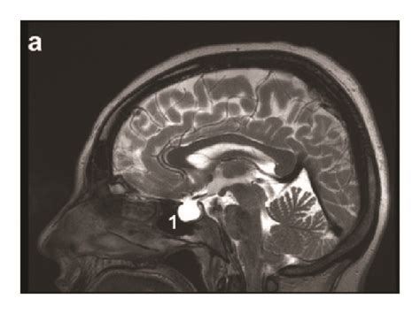 Signs of idiopathic intracranial hypertension on cerebral MRI ...