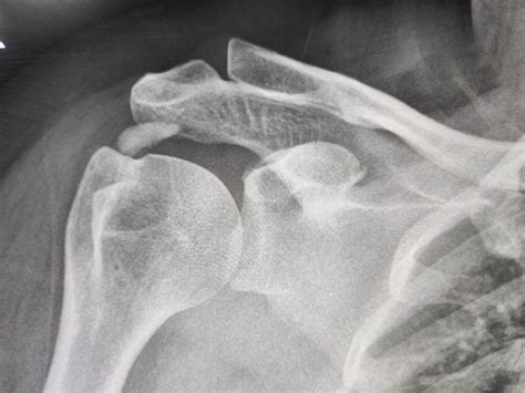 How is shoulder barbotage/lavage "treating calcific tendonitis" done?