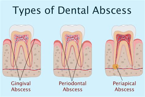 Tooth Abscess: Causes, and How Long Does It Take to Heal?