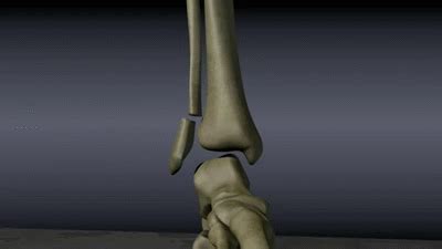 Ankle Fractures on Make a GIF