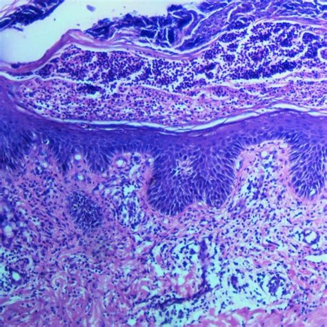 Multiple erythematous pustular lesions in flexural areas of trunk ...