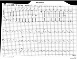 emDOCs.net – Emergency Medicine EducationECG Pointers: Pediatric Junctional Ectopic Tachycardia ...