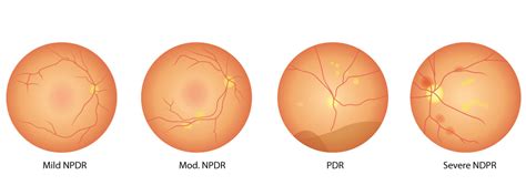 The 4 Stages of Diabetic Retinopathy | Oakbrook Optometry | Diabetic ...