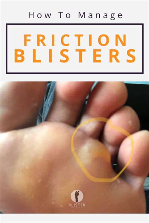 Best Blister Prevention Lubricants, Sticks & Creams | Blister Prevention in 2021 | Blister ...