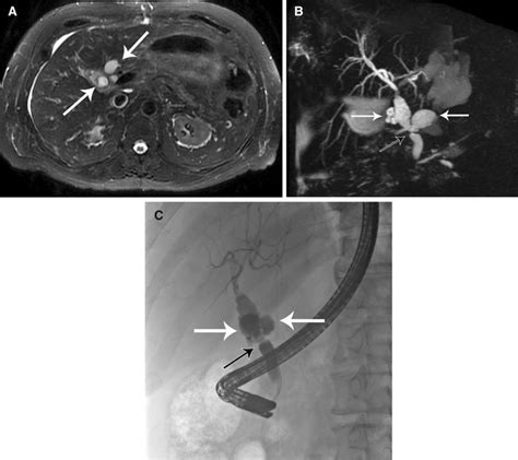 Biliary anastomotic stricture and contained leak. a T2W image with fat... | Download Scientific ...