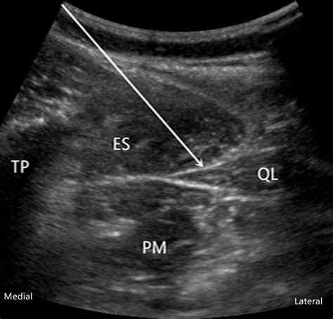 Comparison of ultrasound-guided anterior quadratus lumborum block at the lateral supra-arcuate ...