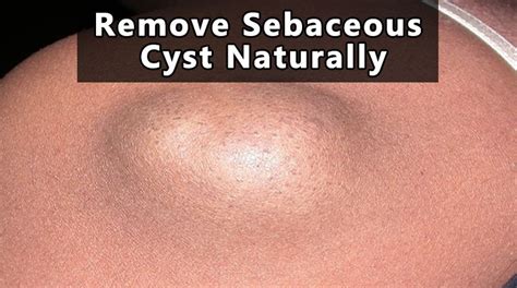 Home Remedies For Managing Sebaceous Cysts - vrogue.co
