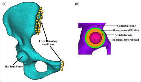 (a) Finite element model of the implanted hemi-pelvis and (b)... | Download Scientific Diagram