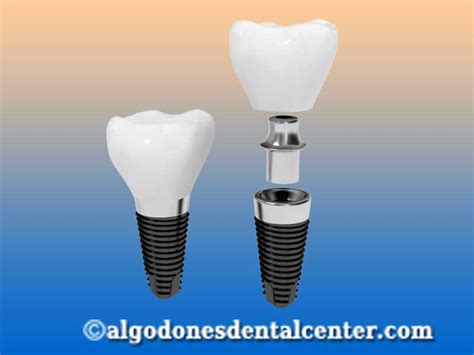 Dental Implants in Algodones near Yuma, AZ | Algodones Dental Center