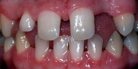 Hypodontia (Missing Teeth) - Kids Dental Plano and Carrollton - Dr ...