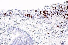 Urothelial carcinoma in situ - Libre Pathology