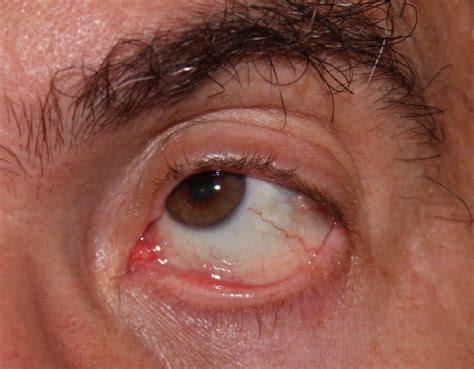 Dry Eye, Autoimmune (Keratoconjunctivitis Sicca) – Gluten Free Works ...