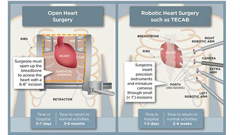 Totally Endoscopic Coronary Artery Bypass (TECAB) Surgery - UChicago Medicine