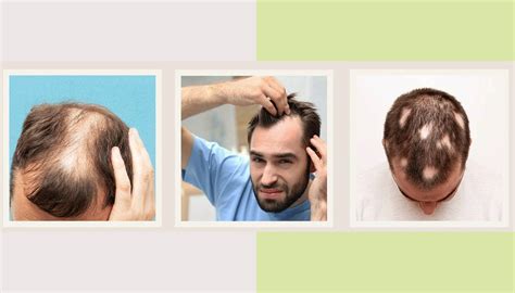 What are the various Abnormal hair loss Signs? - BOTANIQUÉ