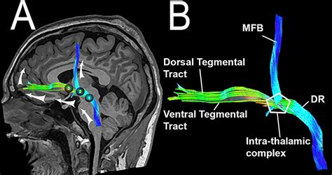 Reconstruction of the Ascending Reticular Activating System with Diffusion Tensor Tractography ...