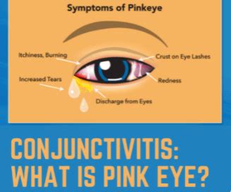 Conjuncivitis: What is Pink Eye? | Georgia Eye Partners