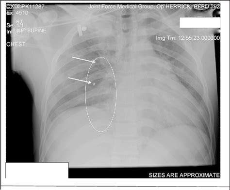 Figure 1 from Avoiding cavity surgery in penetrating torso trauma: the ...