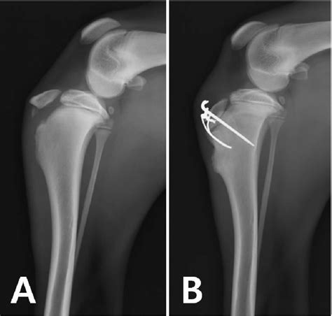 Fibular Avulsion Fracture