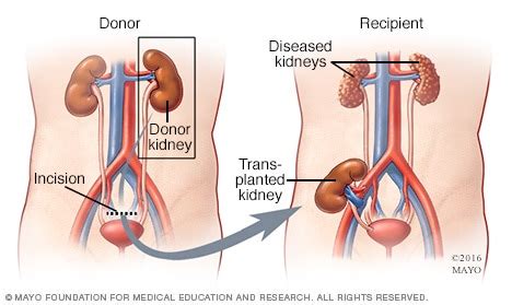 Living-donor kidney transplant - Type - Mayo Clinic