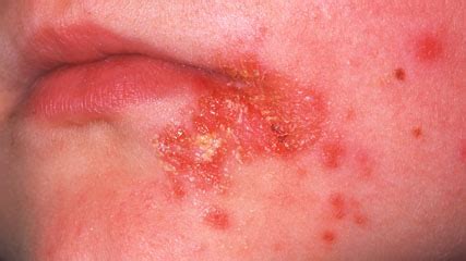 Eczema Complications - Impetigo for Eczema Child - Eczema Blues