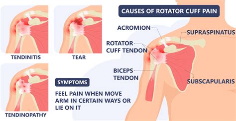 Side Effects Of Cortisone Shot In Shoulder - Stéroïde Légale