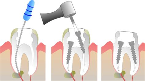 Root canal front tooth - Family Dentistry on Brock