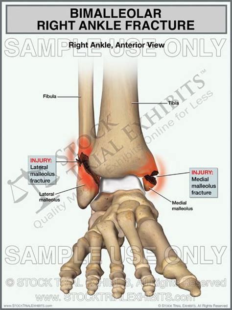 Bimalleolar Ankle Fracture | Ankle fracture, Ankle anatomy, Fracture