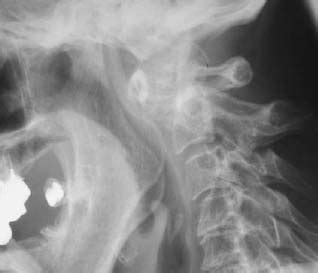 103 Atlantoaxial Instability | Radiology Key