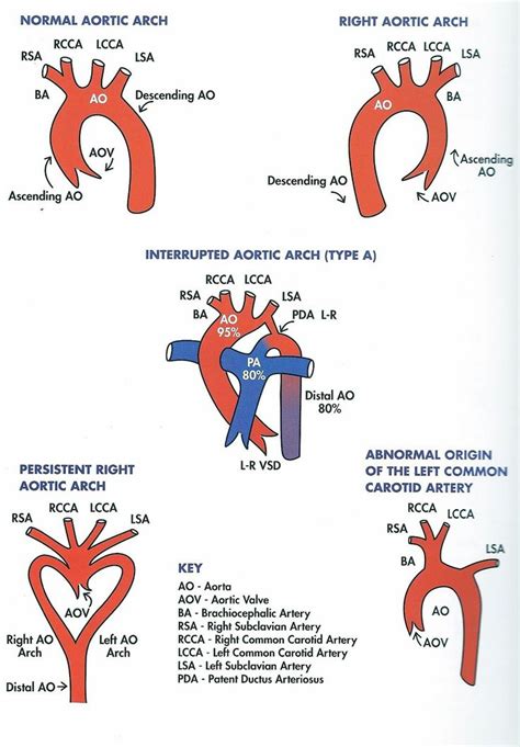 Right sided aortic arch | Medical knowledge, Nursing study, Medicine