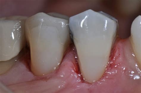 Cervical Abrasion | Composite Resin Restorations