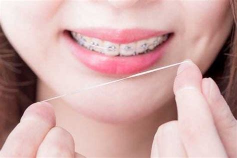 How to Floss With Braces? Step by Step Complete Guide