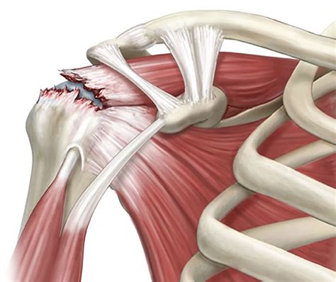 Rotator Cuff Tear | Nona Medical Arts | Shoulder Injury