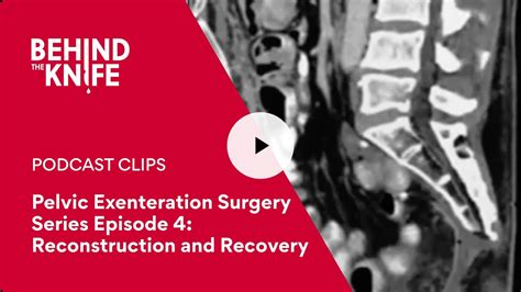 Pelvic Exenteration Surgery Series Episode 4: Reconstruction and Recovery - YouTube