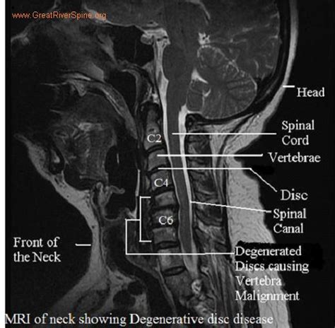 Cervical Disc Degeneration. Causes, symptoms, treatment Cervical Disc ...