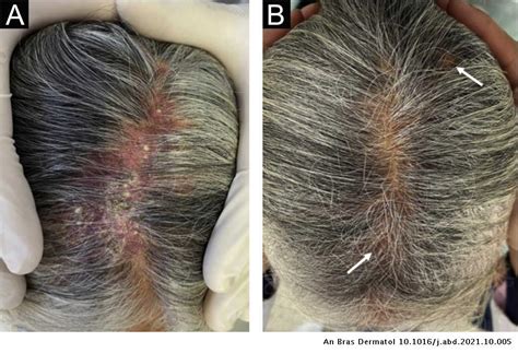 Kerion celsi caused by Trichophyton tonsurans in an adult | Anais ...