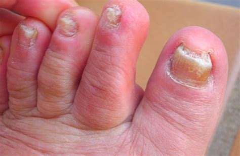 Toenail Fungus: Pictures, Treatment, Home Remedies & Medication