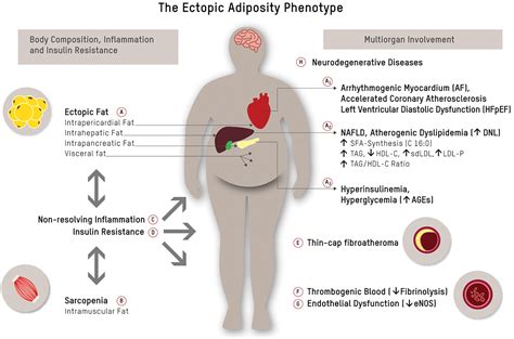 High-Risk Atherosclerosis and Metabolic Phenotype: The Roles of Ectopic Adiposity, Atherogenic ...