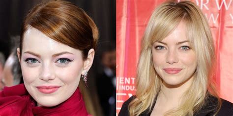 Emma Stone before and after plastic surgery 35 – Celebrity plastic surgery online